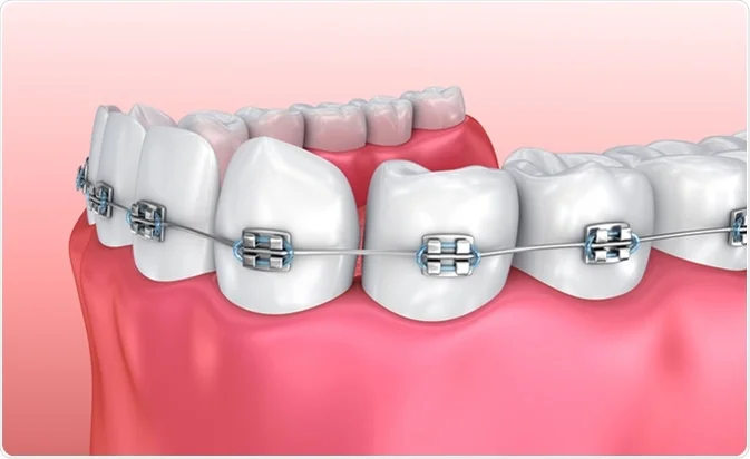 Dental Braces Clinic